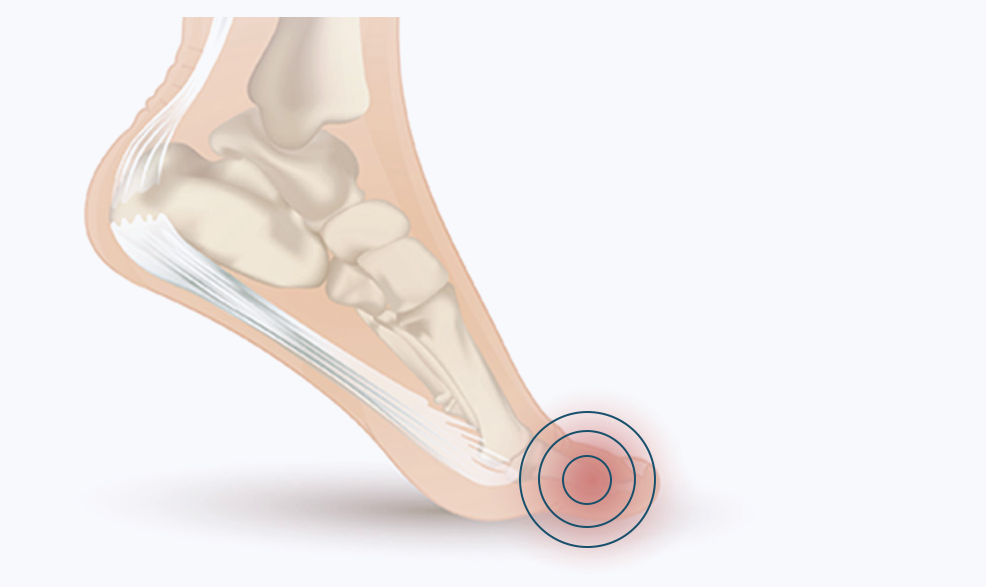 Plantar Fasciitis Pain